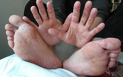 hand, foot and mouth disease: an infection in humans caused by a group of enteroviruses, typically characterized by a mild fever...
