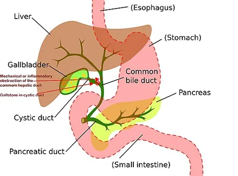 mirizzi's syndrome: a rare complication in which a gallstone becomes impacted in the cystic duct or neck of the gall...