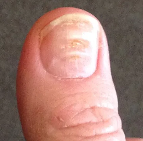 beau's lines: crosswise, linear indentations of fingernails