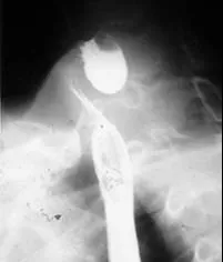 zenker's diverticulum: a pulsion-type false diverticulum of the pharyngoesophageal junction caused by herniation of the...