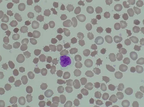 acanthocyte: a pathological, irregularly spiked red blood cell without central pallor