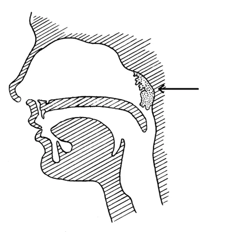adenoid: of or relating to lymphatic glands or lymphoid tissue
