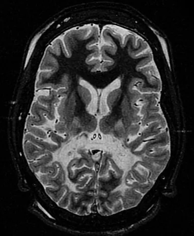 adrenoleukodystrophy: a rare genetic disorder where the body can’t break down certain fatty acids, causing them to build...