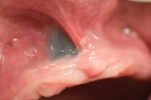 amalgam tattoo: a flat, bluish-gray lesion of the oral mucosa that results from amalgam particles going into the...