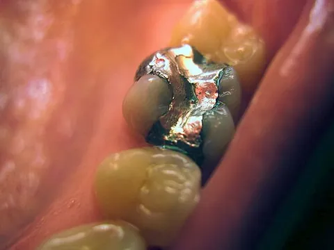 amalgam: an alloy containing mercury