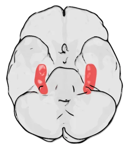 amygdalohippocampectomy: a neurosurgical procedure in which the amygdala and hippocampus, structures in the medial temporal...