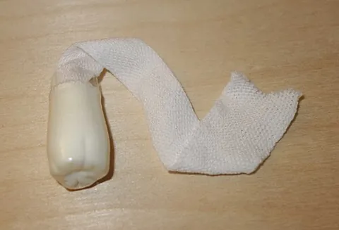 anal plug: a medical device that is often used to treat fecal incontinence