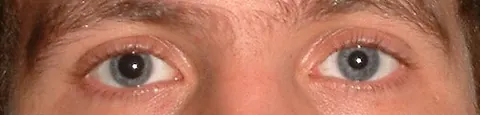 anisocoria: a condition characterized by unequal size of the pupils of the eye