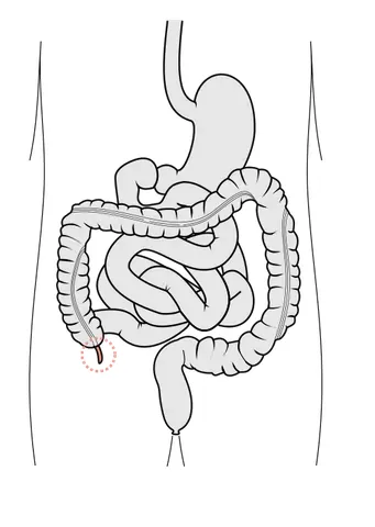 appendix: something attached to something else; an attachment or accompaniment