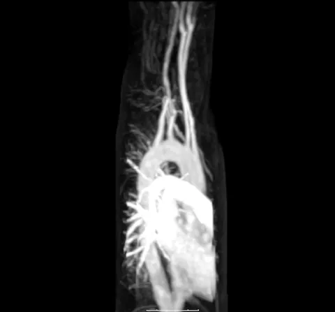 artery: any of the muscular- and elastic-walled blood vessels forming part of the circulation system by...