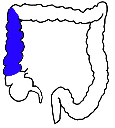 ascending colon: a part of the colon between the cecum and the transverse colon