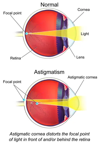 astigmatism: a defect of a lens such that light rays coming from a point do not meet at a focal point so that...