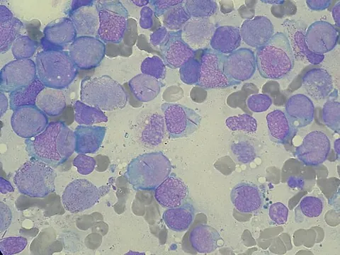 auer rod: clumps of azurophilic granular material that typically form elongated needles seen in the cytoplasm...
