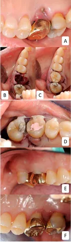 autotransplantation: the surgical transfer of a tissue, organ, or body part from one location to another within the same...
