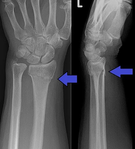 colles' fracture: a distal fracture of the radius causing a dorsal displacement of the distal fragment, typically...