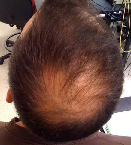 bald spot: an area on the head which, due to hair loss, has little or no hair