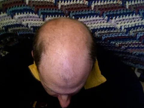 baldness: the condition or state of being (or becoming) bald