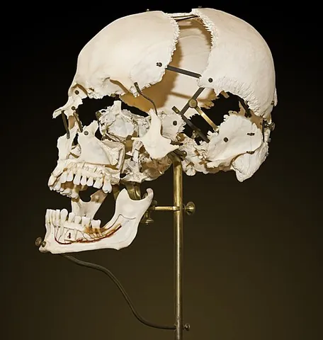 beauchene skull: a specimen of a human skull, used for medical teaching, whose bones are disarticulated along the...