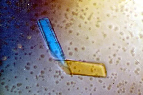 bence jones protein: a monoclonal immunoglobulin light chain originally found in the urine, detection of which may be...