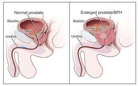 benign prostatic hyperplasia: a noncancerous increase in size of the prostate gland, often resulting in symptoms such as frequent...