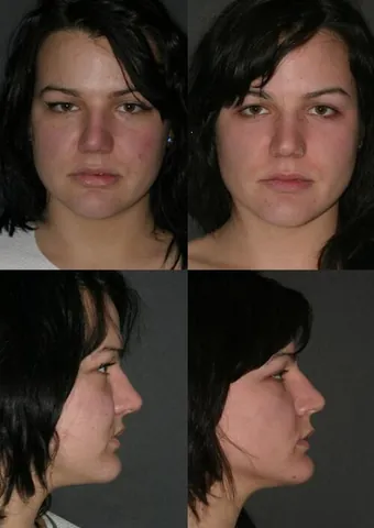 bichectomy: plastic surgery that removes a section of buccal fat-pad tissue from each side of the face