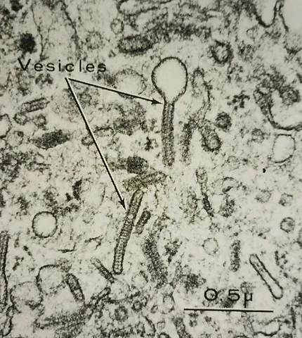 birbeck granule: a rod or tennis racket-shaped cytoplasmic organelle solely found in Langerhans cells and hence a...