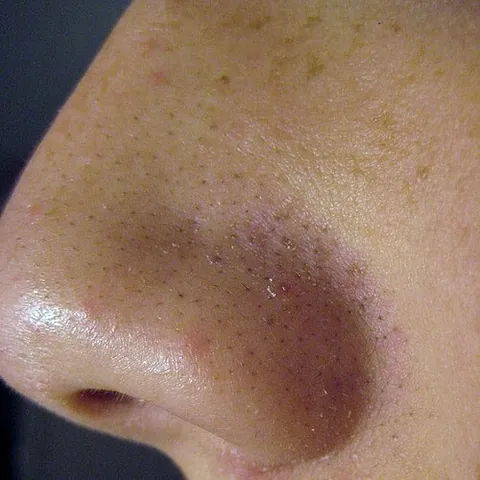 blackhead: a type of comedo, a skin blemish, a type of acne vulgaris, where a pore becomes clogged with a...