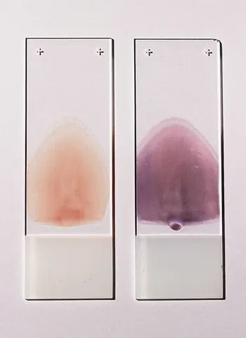 blood film: a thin layer of blood spread on a microscope slide for examination of the various blood cells and...