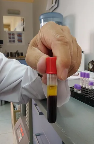 blood serum: the portion of whole blood that is not blood cells and not clotting factors; it can be separated as...