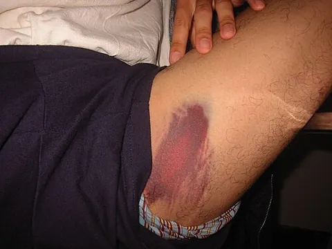 bruise: to strike (a person), originally with something flat or heavy, but now specifically in such a way...