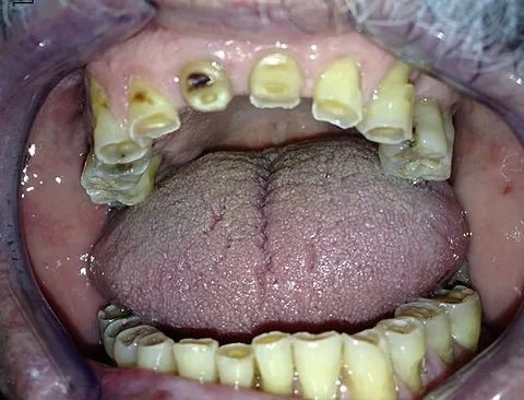 bruxism: the habit or practice of grinding the teeth, as while sleeping, or due to stress or certain drugs