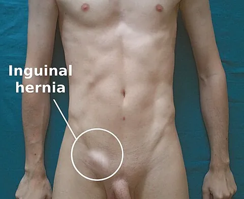 bubonocele: an inguinal hernia, especially of the incomplete variety in which the hernial sac descends only as...