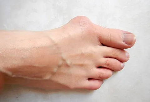 bunion: a bump or bulge on the first joint of the big toe caused by the swelling of a sac of fluid under...