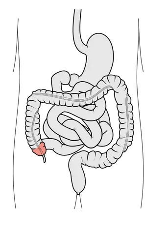 caecum: a cavity open at one end (such as the blind end of a duct), especially a blind pouch connected to...