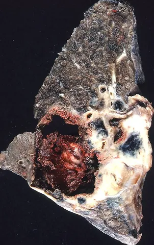 carcinoma: an invasive malignant tumour derived from epithelial tissue that tends to metastasize to other...