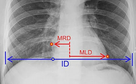 cardiothoracic ratio: the ratio (MRD + MLD) / ID, where MRD is the greatest perpendicular diameter from midline to right...