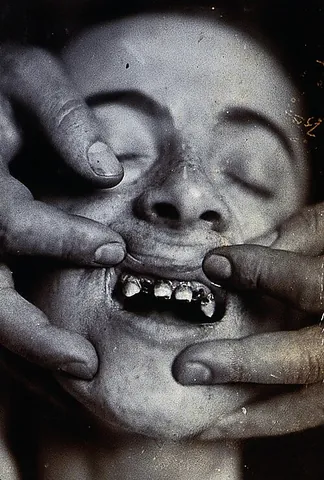 carious: having caries (bone or tooth decay); decayed, rotten