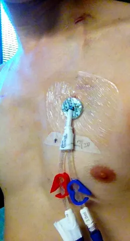 catheter: a small tube inserted into a body cavity to administer a drug, create an opening, distend a...