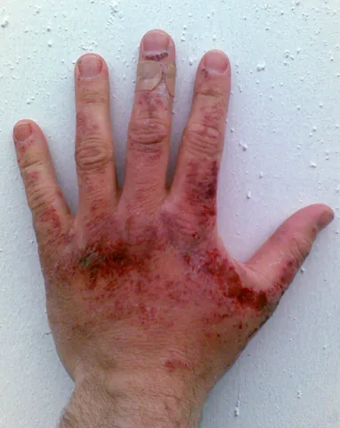 chemical burn: a physical injury of the tissue caused by exposure to chemicals
