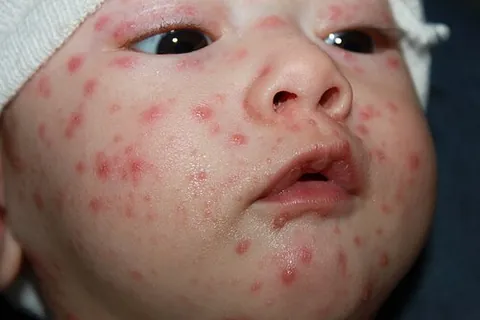 chicken pox: the blisters formed by the varicella zoster virus (VZV)
