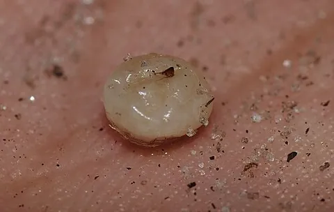 chigoe flea: the chigoe (Tunga penetrans)