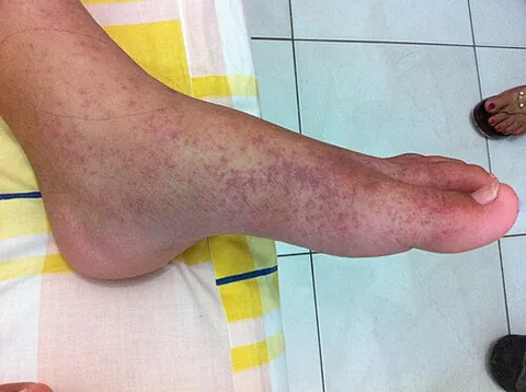 chikungunya: a viral fever caused by the Chikungunya virus, an alphavirus spread by mosquito bites