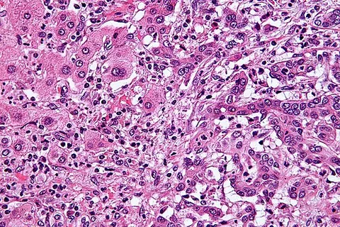 cholangiocarcinoma: a rare and aggressive cancer that starts in the bile ducts