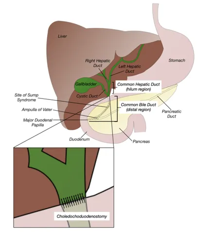 choledochoduodenostomy: a surgical procedure in which an anastomosis is created between the common bile duct and the...