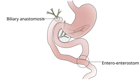 choledochojejunostomy: a surgical procedure that connects the common bile duct to the jejunum to allow bile to bypass an...