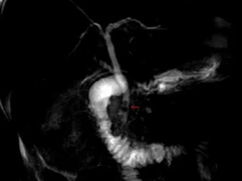 choledocholithiasis: the presence of gallstones in the common bile duct, where they can block bile flow from the liver...