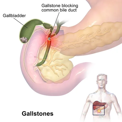 choledocholithotomy: a surgical procedure involving incision of the common bile duct to remove obstructing biliary...