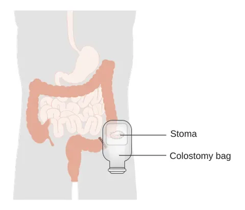 colostomy bag: a small pouch placed over the stoma of a person who has had a colostomy, used to collect waste...