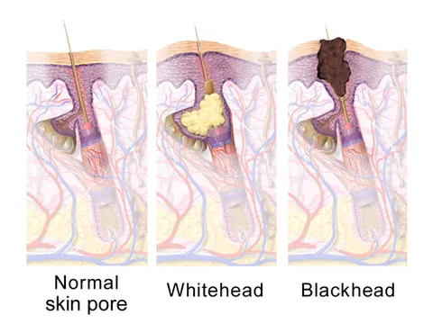 comedo: a clogged hair follicle in the skin, formed when keratin combines with oil to block the follicle
