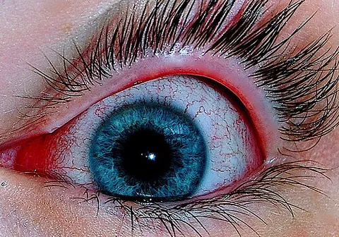 conjunctivitis: an inflammation of the conjunctiva, often due to infection
